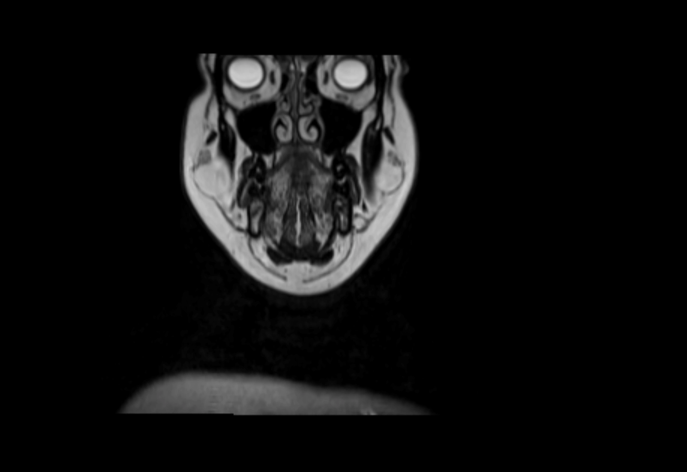 Neck coronal lymph node cross sectional MRI anatomy 3T MRI  image-img-00001-00062.webp